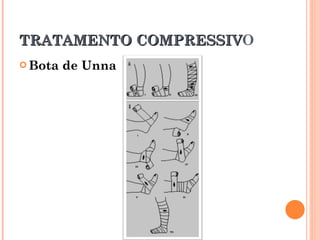 TRATAMENTO COMPRESSIVO
           COMPRESSIV
 Bota   de Unna
 