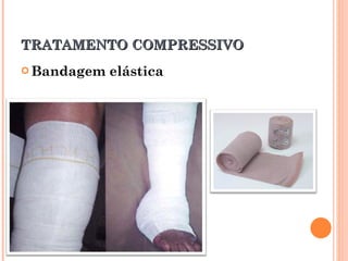 TRATAMENTO COMPRESSIVO
 Bandagem   elástica
 
