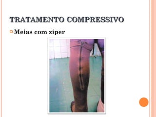 TRATAMENTO COMPRESSIVO
 Meias   com zíper
 