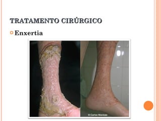 TRATAMENTO CIRÚRGICO
 Enxertia
 