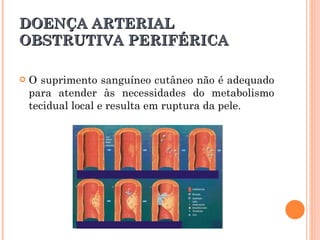 DOENÇA ARTERIAL
OBSTRUTIVA PERIFÉRICA

   O suprimento sanguíneo cutâneo não é adequado
    para atender às necessidades do metabolismo
    tecidual local e resulta em ruptura da pele.
 