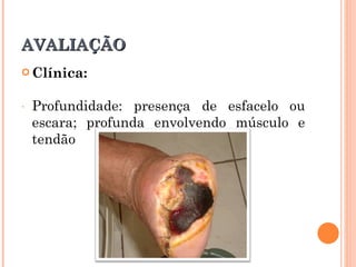 AVALIAÇÃO
 Clínica:


-   Profundidade: presença de esfacelo ou
    escara; profunda envolvendo músculo e
    tendão
 
