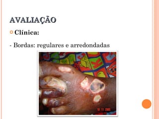 AVALIAÇÃO
 Clínica:


- Bordas: regulares e arredondadas
 