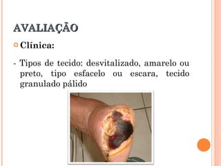 AVALIAÇÃO
 Clínica:


- Tipos de tecido: desvitalizado, amarelo ou
  preto, tipo esfacelo ou escara, tecido
  granulado pálido
 