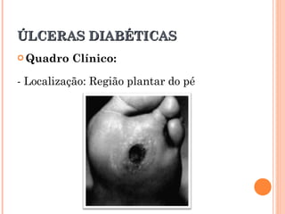 ÚLCERAS DIABÉTICAS
 Quadro   Clínico:

- Localização: Região plantar do pé
 