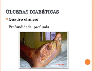 ÚLCERAS DIABÉTICAS
 Quadro    clínico:
-   Profundidade: profunda
 