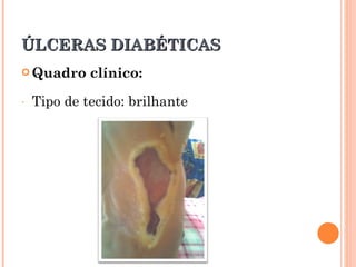 ÚLCERAS DIABÉTICAS
 Quadro     clínico:
-   Tipo de tecido: brilhante
 