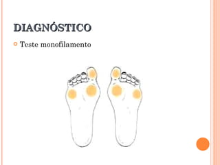 DIAGNÓSTICO
   Teste monofilamento
 