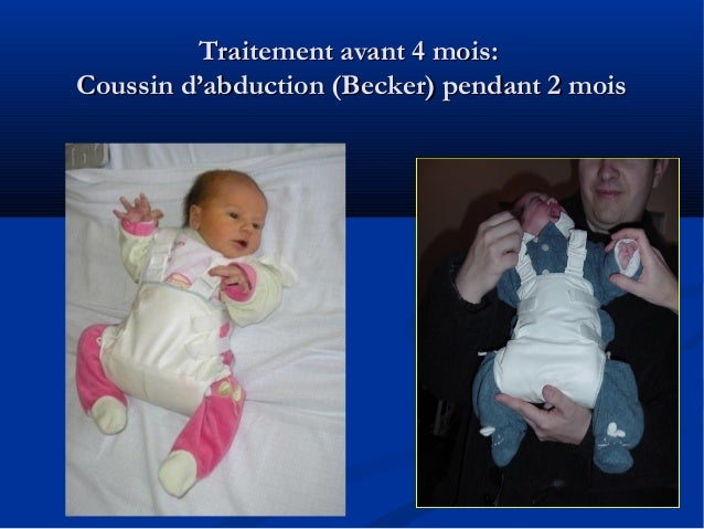 Diagnostic Echographique Precoce De La Luxation Congenitale De La Han Diagnostic Echographique Precoce De La Luxation Congenitale De La Han