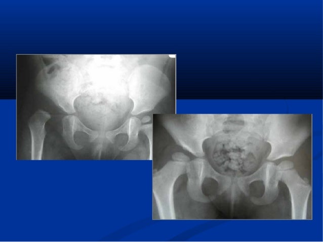 Diagnostic Echographique Precoce De La Luxation Congenitale De La Han