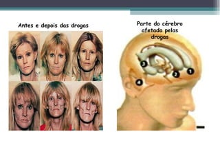 Antes e depois das drogas Parte do cérebro
afetada pelas
drogas
 