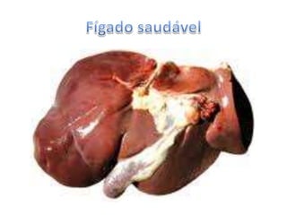 O álcool provoca a cirrose hepática. Cirrose hepáticaCirrose é o nome atribuído à patologia que pode afectar um órgão, transformando o tecido formado pelas suas células originais em tecido fibroso, por um processo habitualmente chamado fibrose ou esclerose.