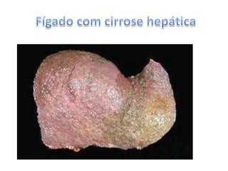 Geralmente o termo cirrose é utilizado para designar a cirrose no fígado.Fígado saudável