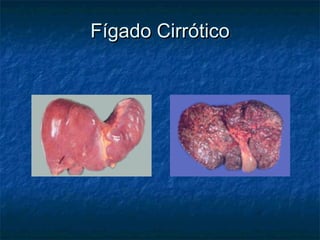 FFíígado Cirrgado Cirróóticotico
 