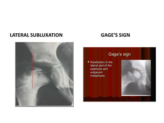 LATERAL SUBLUXATION GAGE’S SIGN
 