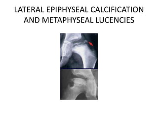 LATERAL EPIPHYSEAL CALCIFICATION
AND METAPHYSEAL LUCENCIES
 