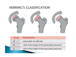 HERRING’S classification
 