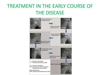 TREATMENT IN THE EARLY COURSE OF
THE DISEASE
 