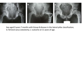 boy aged 9 years 7 months with Group B disease in the lateral pillar classification;
b: femoral varus osteotomy; c: outcome at 11 years of age.
 