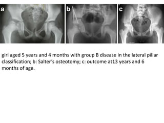 girl aged 5 years and 4 months with group B disease in the lateral pillar
classification; b: Salter’s osteotomy; c: outcome at13 years and 6
months of age.
 