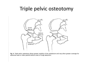Triple pelvic osteotomy
 