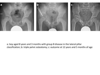 a: boy aged 8 years and 3 months with group B disease in the lateral pillar
classification; b: triple pelvic osteotomy; c: outcome at 12 years and 5 months of age
 