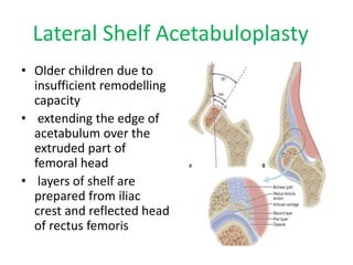 Lateral Shelf Acetabuloplasty
• Older children due to
insufficient remodelling
capacity
• extending the edge of
acetabulum over the
extruded part of
femoral head
• layers of shelf are
prepared from iliac
crest and reflected head
of rectus femoris
 