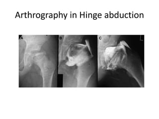 Arthrography in Hinge abduction
 