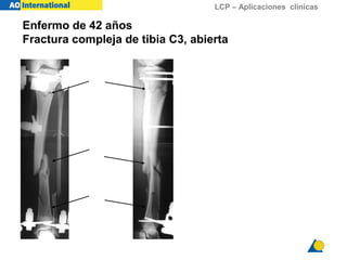 LCP – Aplicaciones clínicas
Enfermo de 42 años
Fractura compleja de tibia C3, abierta
 
