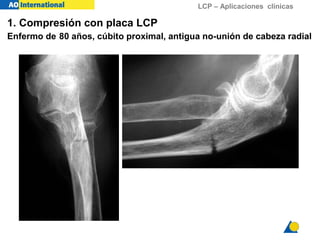 LCP – Aplicaciones clínicas
1. Compresión con placa LCP
Enfermo de 80 años, cúbito proximal, antigua no-unión de cabeza radial
 