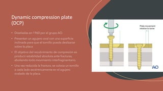 LCP DC LCDCP placas de traumatología y ortopedia | PDF