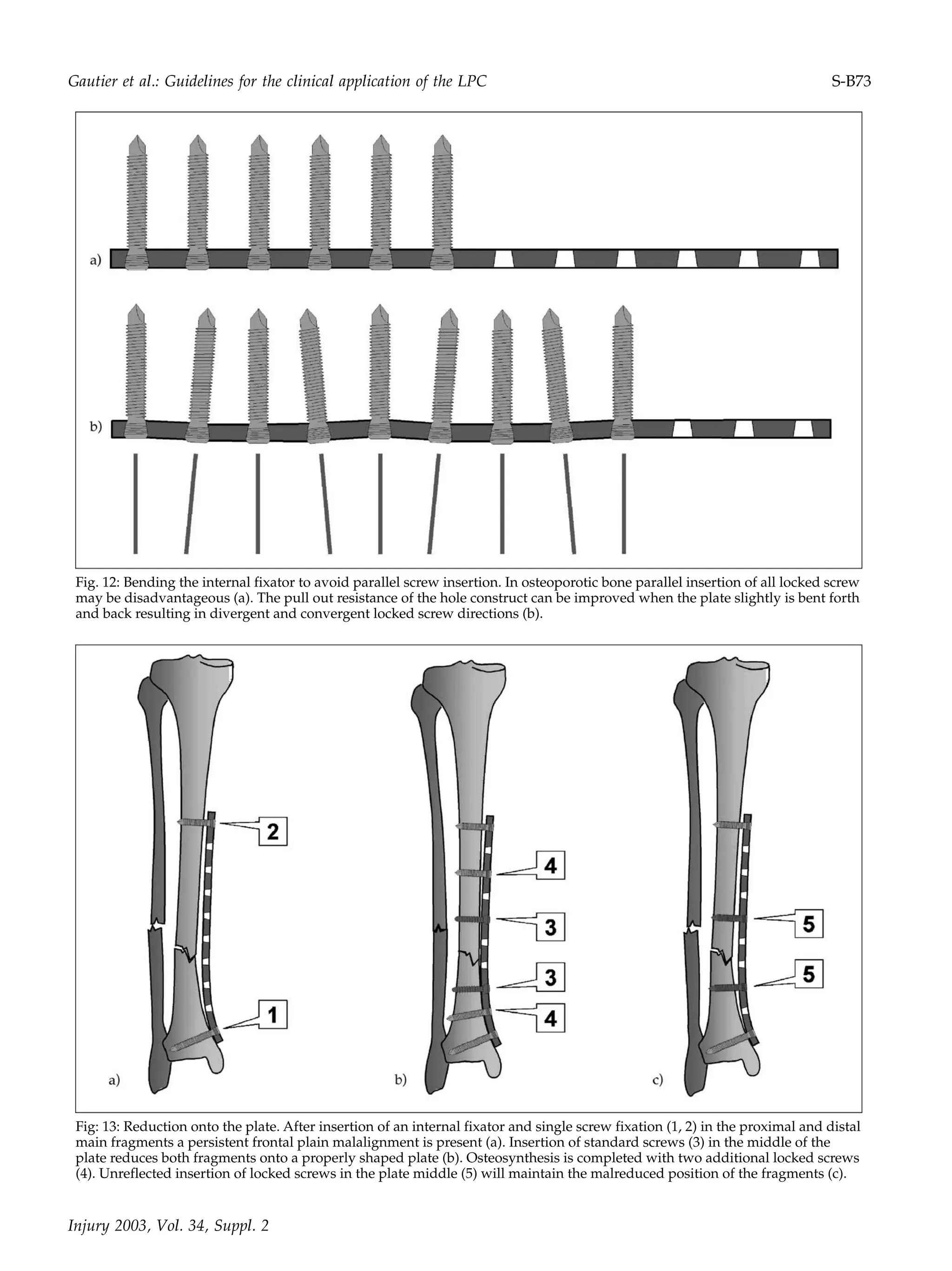 Injury 2003, Vol. 34, Suppl. 2
Fig. 12: Bending the internal fixator to avoid parallel screw insertion. In osteoporotic bone parallel insertion of all locked screw
may be disadvantageous (a). The pull out resistance of the hole construct can be improved when the plate slightly is bent forth
and back resulting in divergent and convergent locked screw directions (b).
Fig: 13: Reduction onto the plate. After insertion of an internal fixator and single screw fixation (1, 2) in the proximal and distal
main fragments a persistent frontal plain malalignment is present (a). Insertion of standard screws (3) in the middle of the
plate reduces both fragments onto a properly shaped plate (b). Osteosynthesis is completed with two additional locked screws
(4). Unreflected insertion of locked screws in the plate middle (5) will maintain the malreduced position of the fragments (c).
Gautier et al.: Guidelines for the clinical application of the LPC S-B73
 