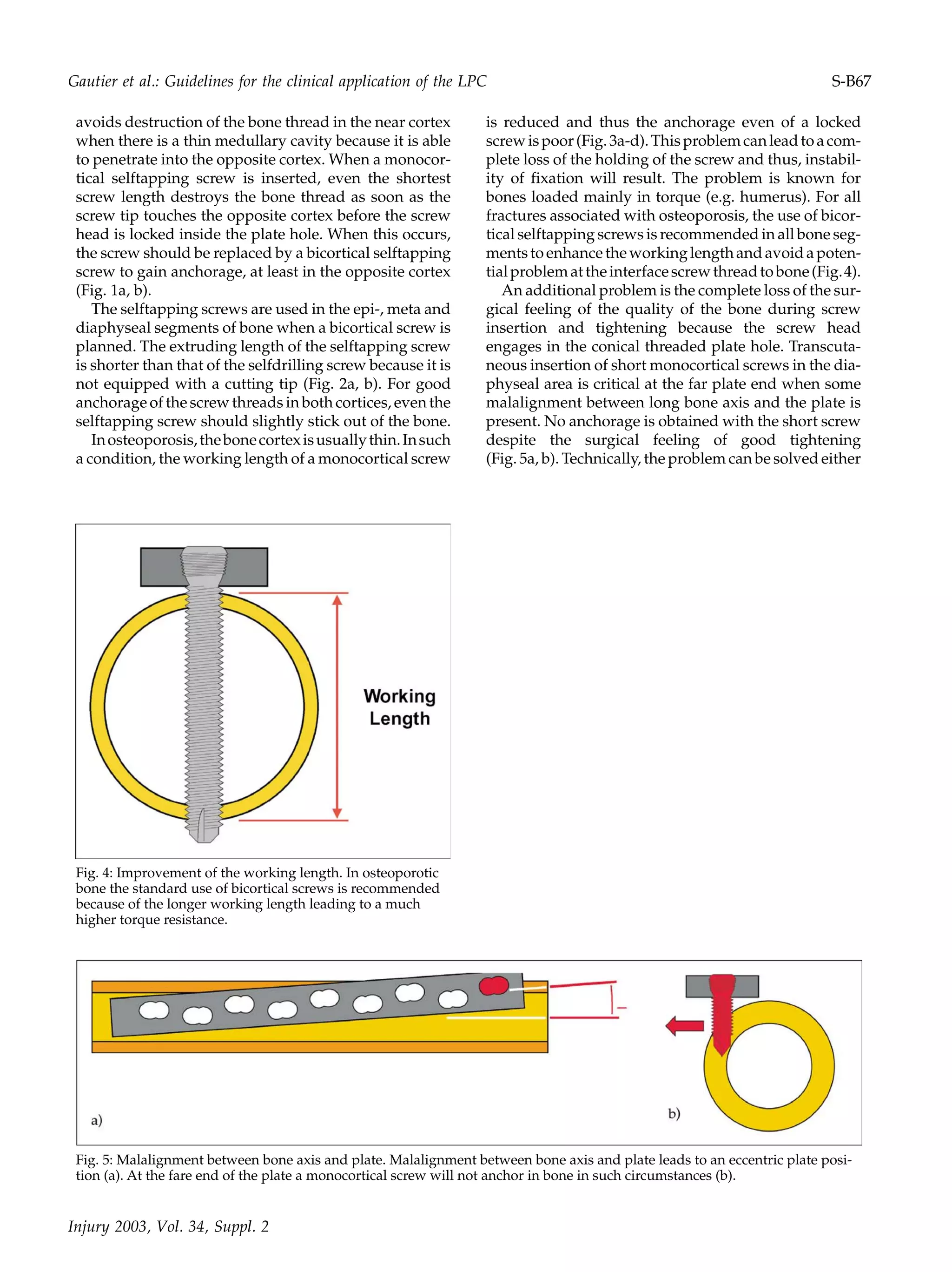 avoids destruction of the bone thread in the near cortex
when there is a thin medullary cavity because it is able
to penetrate into the opposite cortex. When a monocor-
tical selftapping screw is inserted, even the shortest
screw length destroys the bone thread as soon as the
screw tip touches the opposite cortex before the screw
head is locked inside the plate hole. When this occurs,
the screw should be replaced by a bicortical selftapping
screw to gain anchorage, at least in the opposite cortex
(Fig. 1a, b).
The selftapping screws are used in the epi-, meta and
diaphyseal segments of bone when a bicortical screw is
planned. The extruding length of the selftapping screw
is shorter than that of the selfdrilling screw because it is
not equipped with a cutting tip (Fig. 2a, b). For good
anchorage of the screw threads in both cortices, even the
selftapping screw should slightly stick out of the bone.
Inosteoporosis,thebonecortexisusuallythin.Insuch
a condition, the working length of a monocortical screw
is reduced and thus the anchorage even of a locked
screwispoor(Fig.3a-d).Thisproblemcanleadtoacom-
plete loss of the holding of the screw and thus, instabil-
ity of fixation will result. The problem is known for
bones loaded mainly in torque (e.g. humerus). For all
fractures associated with osteoporosis, the use of bicor-
tical selftapping screws is recommended in all bone seg-
mentstoenhancetheworkinglengthandavoidapoten-
tialproblemattheinterfacescrewthreadtobone(Fig.4).
An additional problem is the complete loss of the sur-
gical feeling of the quality of the bone during screw
insertion and tightening because the screw head
engages in the conical threaded plate hole. Transcuta-
neous insertion of short monocortical screws in the dia-
physeal area is critical at the far plate end when some
malalignment between long bone axis and the plate is
present. No anchorage is obtained with the short screw
despite the surgical feeling of good tightening
(Fig. 5a, b). Technically, the problem can be solved either
Fig. 4: Improvement of the working length. In osteoporotic
bone the standard use of bicortical screws is recommended
because of the longer working length leading to a much
higher torque resistance.
Fig. 5: Malalignment between bone axis and plate. Malalignment between bone axis and plate leads to an eccentric plate posi-
tion (a). At the fare end of the plate a monocortical screw will not anchor in bone in such circumstances (b).
Injury 2003, Vol. 34, Suppl. 2
Gautier et al.: Guidelines for the clinical application of the LPC S-B67
 