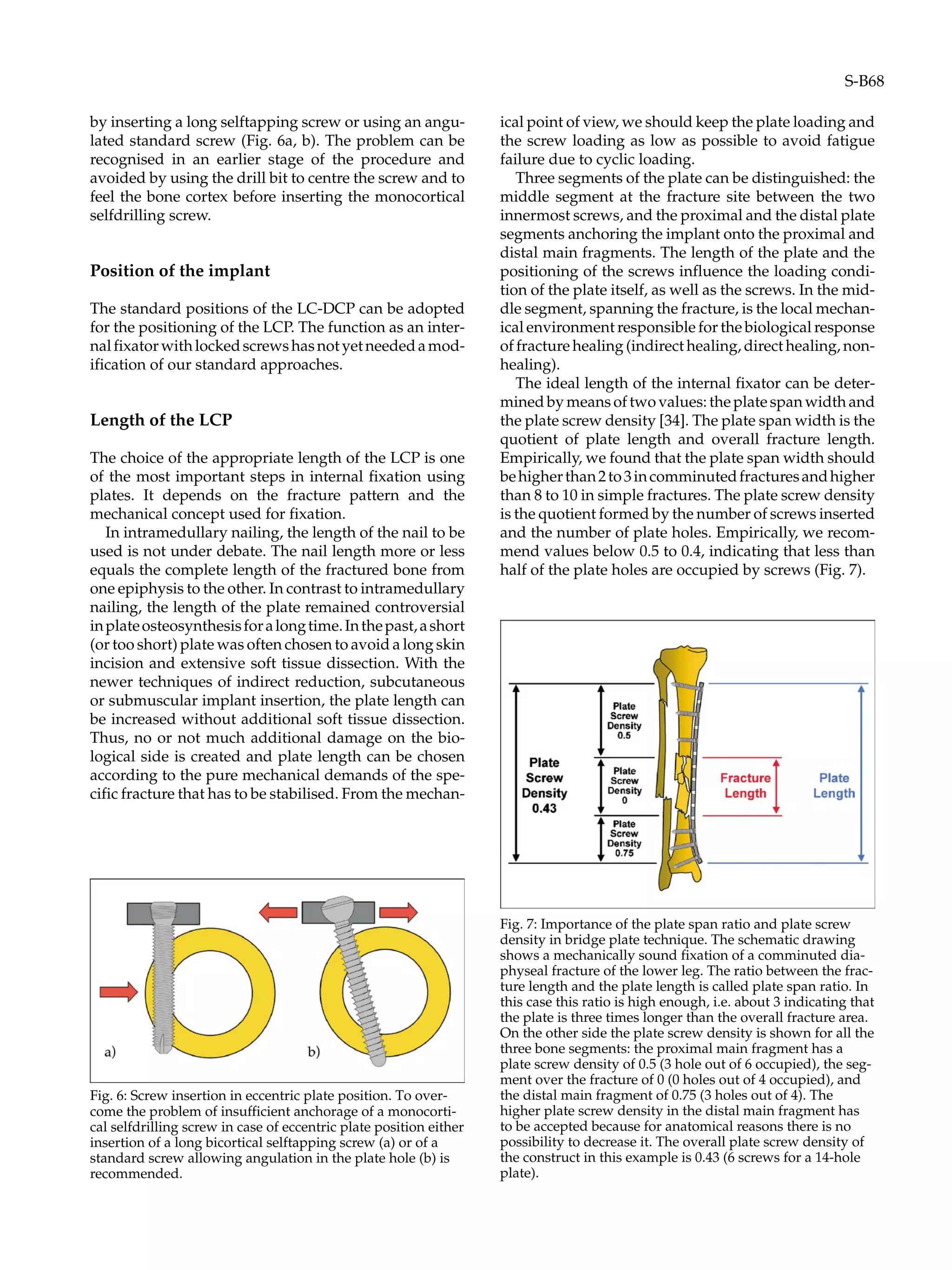 by inserting a long selftapping screw or using an angu-
lated standard screw (Fig. 6a, b). The problem can be
recognised in an earlier stage of the procedure and
avoided by using the drill bit to centre the screw and to
feel the bone cortex before inserting the monocortical
selfdrilling screw.
Position of the implant
The standard positions of the LC-DCP can be adopted
for the positioning of the LCP. The function as an inter-
nalfixatorwithlockedscrewshasnotyetneededamod-
ification of our standard approaches.
Length of the LCP
The choice of the appropriate length of the LCP is one
of the most important steps in internal fixation using
plates. It depends on the fracture pattern and the
mechanical concept used for fixation.
In intramedullary nailing, the length of the nail to be
used is not under debate. The nail length more or less
equals the complete length of the fractured bone from
one epiphysis to the other. In contrast to intramedullary
nailing, the length of the plate remained controversial
inplateosteosynthesisforalongtime.Inthepast,ashort
(or too short) plate was often chosen to avoid a long skin
incision and extensive soft tissue dissection. With the
newer techniques of indirect reduction, subcutaneous
or submuscular implant insertion, the plate length can
be increased without additional soft tissue dissection.
Thus, no or not much additional damage on the bio-
logical side is created and plate length can be chosen
according to the pure mechanical demands of the spe-
cific fracture that has to be stabilised. From the mechan-
ical point of view, we should keep the plate loading and
the screw loading as low as possible to avoid fatigue
failure due to cyclic loading.
Three segments of the plate can be distinguished: the
middle segment at the fracture site between the two
innermost screws, and the proximal and the distal plate
segments anchoring the implant onto the proximal and
distal main fragments. The length of the plate and the
positioning of the screws influence the loading condi-
tion of the plate itself, as well as the screws. In the mid-
dle segment, spanning the fracture, is the local mechan-
ical environment responsible for the biological response
of fracture healing (indirect healing, direct healing, non-
healing).
The ideal length of the internal fixator can be deter-
mined by means of two values: the plate span width and
the plate screw density [34]. The plate span width is the
quotient of plate length and overall fracture length.
Empirically, we found that the plate span width should
behigherthan2to3incomminutedfracturesandhigher
than 8 to 10 in simple fractures. The plate screw density
is the quotient formed by the number of screws inserted
and the number of plate holes. Empirically, we recom-
mend values below 0.5 to 0.4, indicating that less than
half of the plate holes are occupied by screws (Fig. 7).
come the pr
Fig. 6: Screw insertion in eccentric plate position. To over-
oblem of insufficient anchorage of a monocorti-
cal selfdrilling screw in case of eccentric plate position either
insertion of a long bicortical selftapping screw (a) or of a
standard screw allowing angulation in the plate hole (b) is
recommended.
Fig. 7: Importance of the plate span ratio and plate screw
density in bridge plate technique. The schematic drawing
shows a mechanically sound fixation of a comminuted dia-
physeal fracture of the lower leg. The ratio between the frac-
ture length and the plate length is called plate span ratio. In
this case this ratio is high enough, i.e. about 3 indicating that
the plate is three times longer than the overall fracture area.
On the other side the plate screw density is shown for all the
three bone segments: the proximal main fragment has a
plate screw density of 0.5 (3 hole out of 6 occupied), the seg-
ment over the fracture of 0 (0 holes out of 4 occupied), and
the distal main fragment of 0.75 (3 holes out of 4). The
higher plate screw density in the distal main fragment has
to be accepted because for anatomical reasons there is no
possibility to decrease it. The overall plate screw density of
the construct in this example is 0.43 (6 screws for a 14-hole
plate).
S-B68
 
