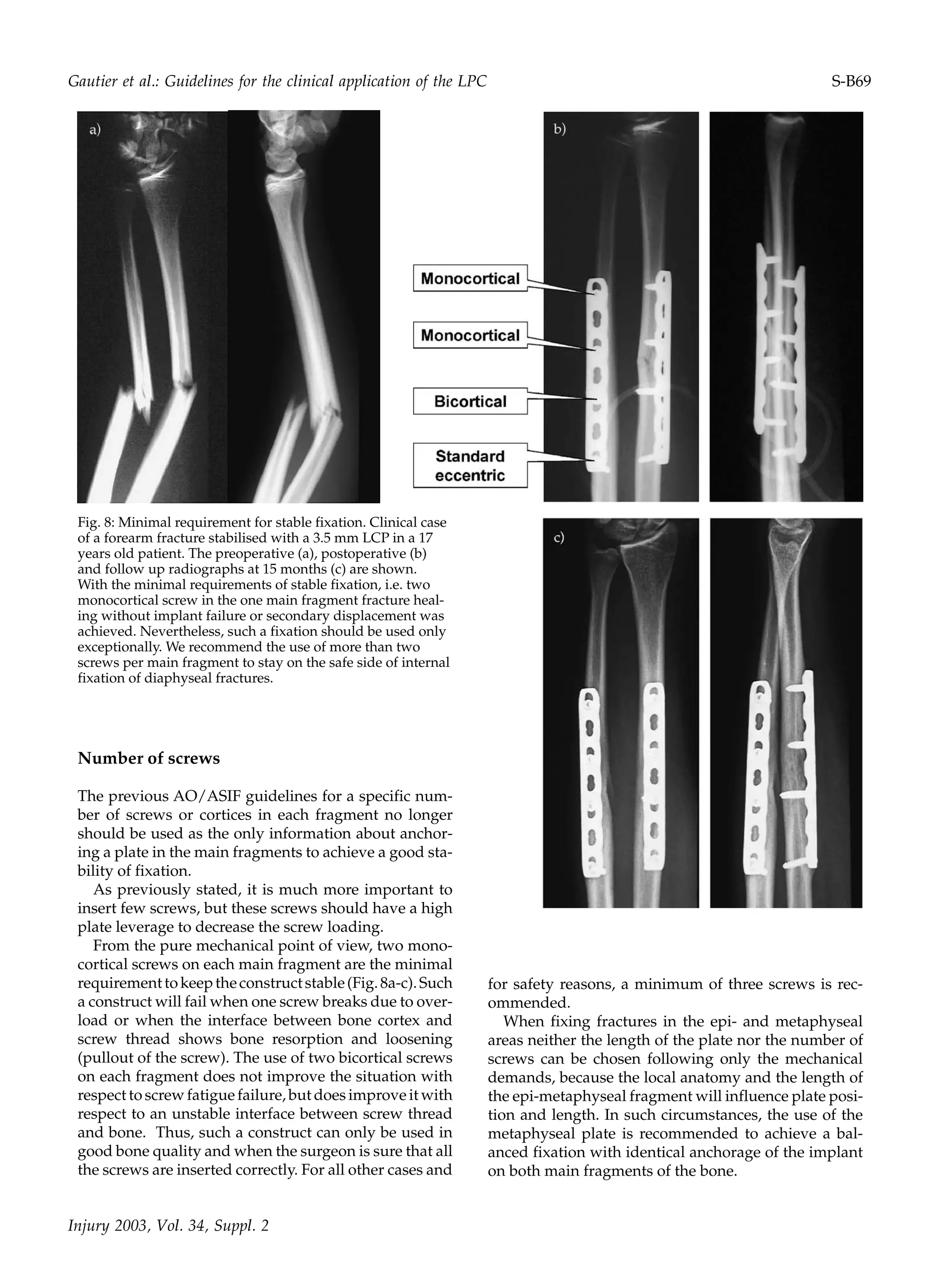 Number of screws
The previous AO/ASIF guidelines for a specific num-
ber of screws or cortices in each fragment no longer
should be used as the only information about anchor-
ing a plate in the main fragments to achieve a good sta-
bility of fixation.
As previously stated, it is much more important to
insert few screws, but these screws should have a high
plate leverage to decrease the screw loading.
From the pure mechanical point of view, two mono-
cortical screws on each main fragment are the minimal
requirementtokeeptheconstructstable(Fig.8a-c).Such
a construct will fail when one screw breaks due to over-
load or when the interface between bone cortex and
screw thread shows bone resorption and loosening
(pullout of the screw). The use of two bicortical screws
on each fragment does not improve the situation with
respect to screw fatigue failure, but does improve it with
respect to an unstable interface between screw thread
and bone. Thus, such a construct can only be used in
good bone quality and when the surgeon is sure that all
the screws are inserted correctly. For all other cases and
Fig. 8: Minimal requirement for stable fixation. Clinical case
of a forearm fracture stabilised with a 3.5 mm LCP in a 17
years old patient. The preoperative (a), postoperative (b)
and follow up radiographs at 15 months (c) are shown.
With the minimal requirements of stable fixation, i.e. two
monocortical screw in the one main fragment fracture heal-
ing without implant failure or secondary displacement was
achieved. Nevertheless, such a fixation should be used only
exceptionally. We recommend the use of more than two
screws per main fragment to stay on the safe side of internal
fixation of diaphyseal fractures.
for safety reasons, a minimum of three screws is rec-
ommended.
When fixing fractures in the epi- and metaphyseal
areas neither the length of the plate nor the number of
screws can be chosen following only the mechanical
demands, because the local anatomy and the length of
the epi-metaphyseal fragment will influence plate posi-
tion and length. In such circumstances, the use of the
metaphyseal plate is recommended to achieve a bal-
anced fixation with identical anchorage of the implant
on both main fragments of the bone.
Injury 2003, Vol. 34, Suppl. 2
Gautier et al.: Guidelines for the clinical application of the LPC S-B69
 