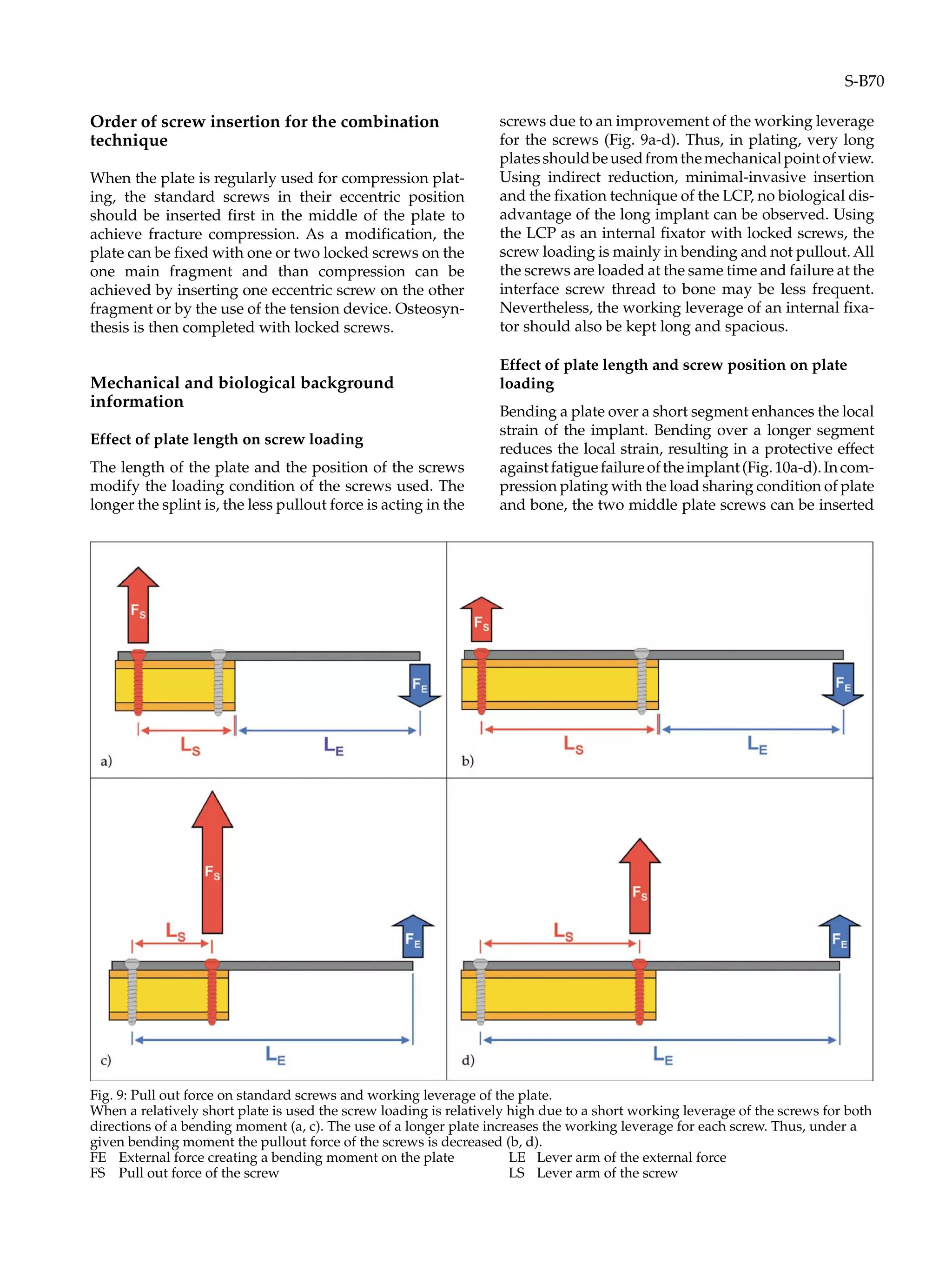 Order of screw insertion for the combination
technique
When the plate is regularly used for compression plat-
ing, the standard screws in their eccentric position
should be inserted first in the middle of the plate to
achieve fracture compression. As a modification, the
plate can be fixed with one or two locked screws on the
one main fragment and than compression can be
achieved by inserting one eccentric screw on the other
fragment or by the use of the tension device. Osteosyn-
thesis is then completed with locked screws.
Mechanical and biological background
information
Effect of plate length on screw loading
The length of the plate and the position of the screws
modify the loading condition of the screws used. The
longer the splint is, the less pullout force is acting in the
screws due to an improvement of the working leverage
for the screws (Fig. 9a-d). Thus, in plating, very long
platesshouldbeusedfromthemechanicalpointofview.
Using indirect reduction, minimal-invasive insertion
and the fixation technique of the LCP, no biological dis-
advantage of the long implant can be observed. Using
the LCP as an internal fixator with locked screws, the
screw loading is mainly in bending and not pullout. All
the screws are loaded at the same time and failure at the
interface screw thread to bone may be less frequent.
Nevertheless, the working leverage of an internal fixa-
tor should also be kept long and spacious.
Effect of plate length and screw position on plate
loading
Bending a plate over a short segment enhances the local
strain of the implant. Bending over a longer segment
reduces the local strain, resulting in a protective effect
againstfatiguefailureoftheimplant(Fig.10a-d).Incom-
pression plating with the load sharing condition of plate
and bone, the two middle plate screws can be inserted
Fig. 9: Pull out force on standard screws and working leverage of the plate.
When a relatively short plate is used the screw loading is relatively high due to a short working leverage of the screws for both
directions of a bending moment (a, c). The use of a longer plate increases the working leverage for each screw. Thus, under a
given bending moment the pullout force of the screws is decreased (b, d).
FE External force creating a bending moment on the plate LE Lever arm of the external force
FS Pull out force of the screw LS Lever arm of the screw
S-B70
 