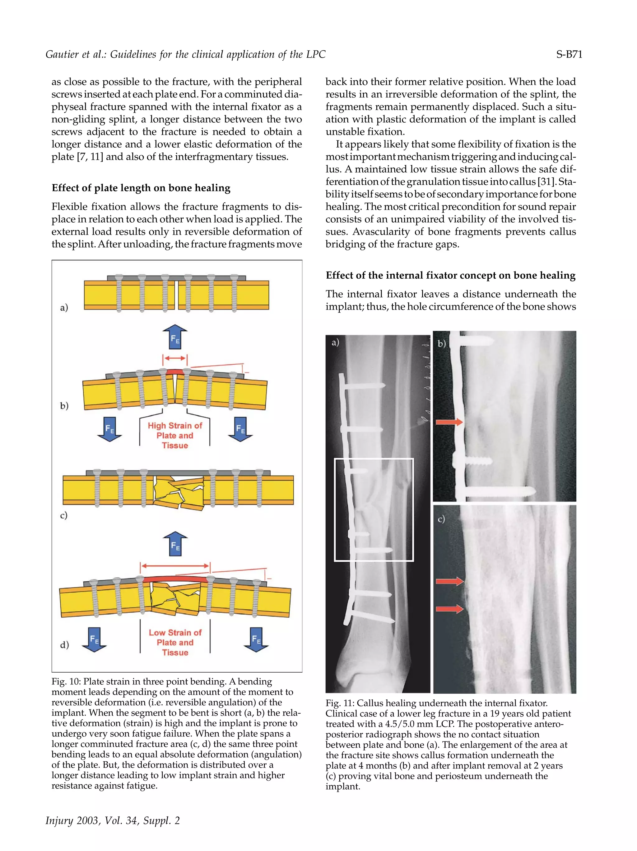 as close as possible to the fracture, with the peripheral
screws inserted at each plate end. For a comminuted dia-
physeal fracture spanned with the internal fixator as a
non-gliding splint, a longer distance between the two
screws adjacent to the fracture is needed to obtain a
longer distance and a lower elastic deformation of the
plate [7, 11] and also of the interfragmentary tissues.
Effect of plate length on bone healing
Flexible fixation allows the fracture fragments to dis-
place in relation to each other when load is applied. The
external load results only in reversible deformation of
the splint.After unloading, the fracture fragments move
back into their former relative position. When the load
results in an irreversible deformation of the splint, the
fragments remain permanently displaced. Such a situ-
ation with plastic deformation of the implant is called
unstable fixation.
It appears likely that some flexibility of fixation is the
mostimportantmechanismtriggeringandinducingcal-
lus. A maintained low tissue strain allows the safe dif-
ferentiationofthegranulationtissueintocallus[31].Sta-
bilityitselfseemstobeofsecondaryimportanceforbone
healing. The most critical precondition for sound repair
consists of an unimpaired viability of the involved tis-
sues. Avascularity of bone fragments prevents callus
bridging of the fracture gaps.
Effect of the internal fixator concept on bone healing
The internal fixator leaves a distance underneath the
implant; thus, the hole circumference of the bone shows
Fig. 10: Plate strain in three point bending. A bending
moment leads depending on the amount of the moment to
reversible deformation (i.e. reversible angulation) of the
implant. When the segment to be bent is short (a, b) the rela-
tive deformation (strain) is high and the implant is prone to
undergo very soon fatigue failure. When the plate spans a
longer comminuted fracture area (c, d) the same three point
bending leads to an equal absolute deformation (angulation)
of the plate. But, the deformation is distributed over a
longer distance leading to low implant strain and higher
resistance against fatigue.
Fig. 11: Callus healing underneath the internal fixator.
Clinical case of a lower leg fracture in a 19 years old patient
treated with a 4.5/5.0 mm LCP. The postoperative antero-
posterior radiograph shows the no contact situation
between plate and bone (a). The enlargement of the area at
the fracture site shows callus formation underneath the
plate at 4 months (b) and after implant removal at 2 years
(c) proving vital bone and periosteum underneath the
implant.
Injury 2003, Vol. 34, Suppl. 2
Gautier et al.: Guidelines for the clinical application of the LPC S-B71
 