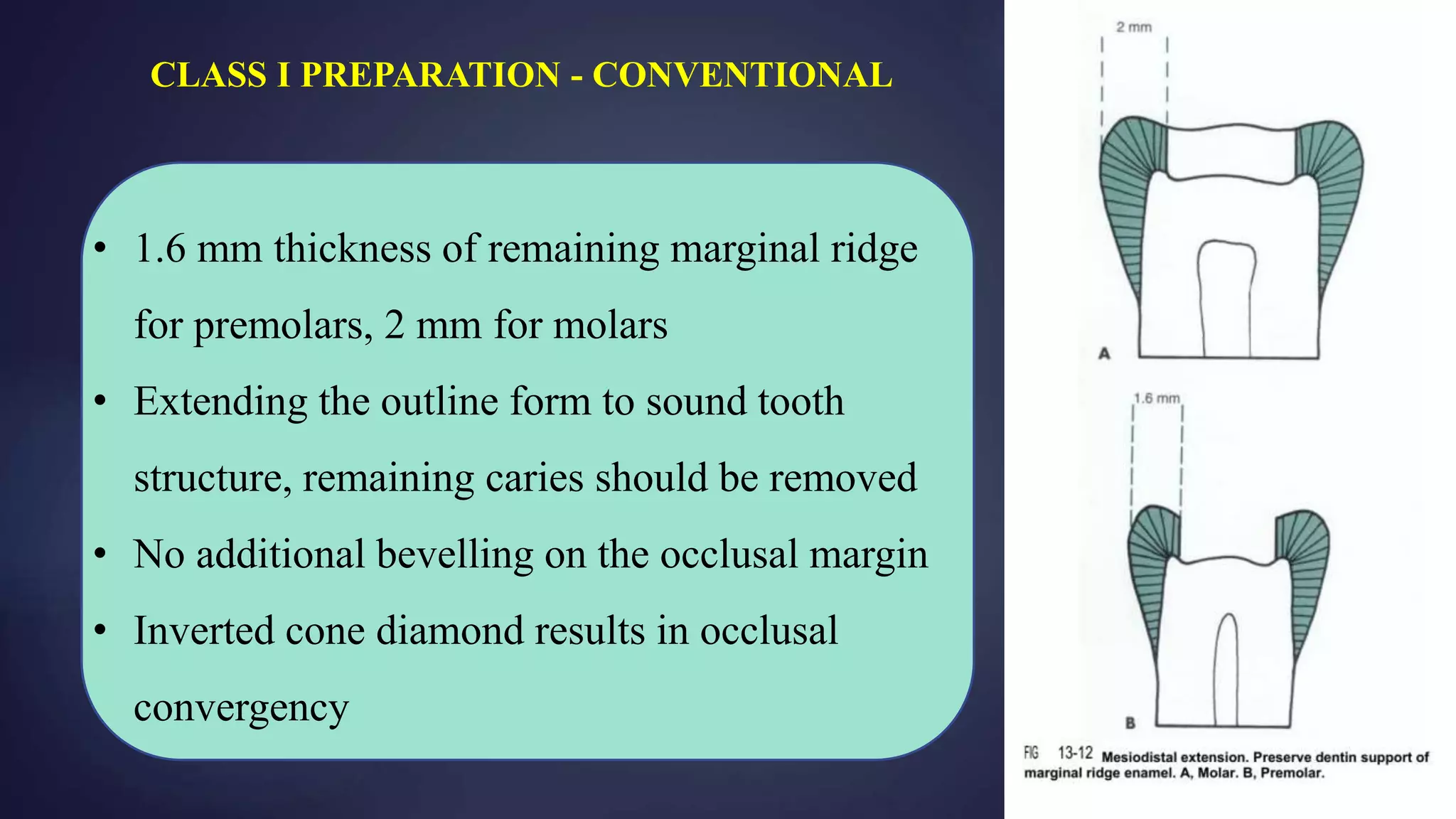 • 1.6 mm thickness of remaining marginal ridge
for premolars, 2 mm for molars
• Extending the outline form to sound tooth
structure, remaining caries should be removed
• No additional bevelling on the occlusal margin
• Inverted cone diamond results in occlusal
convergency
CLASS I PREPARATION - CONVENTIONAL
 