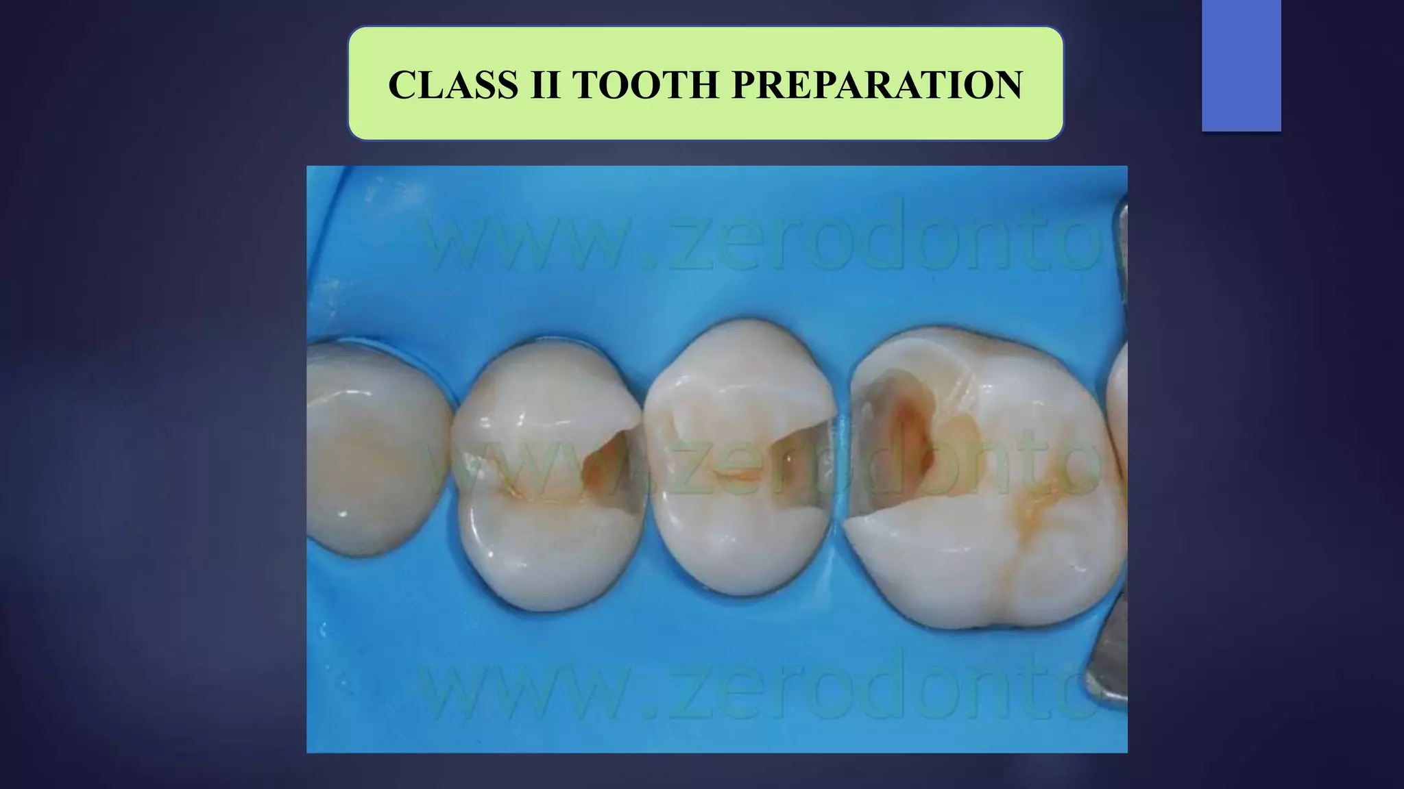 CLASS II TOOTH PREPARATION
 