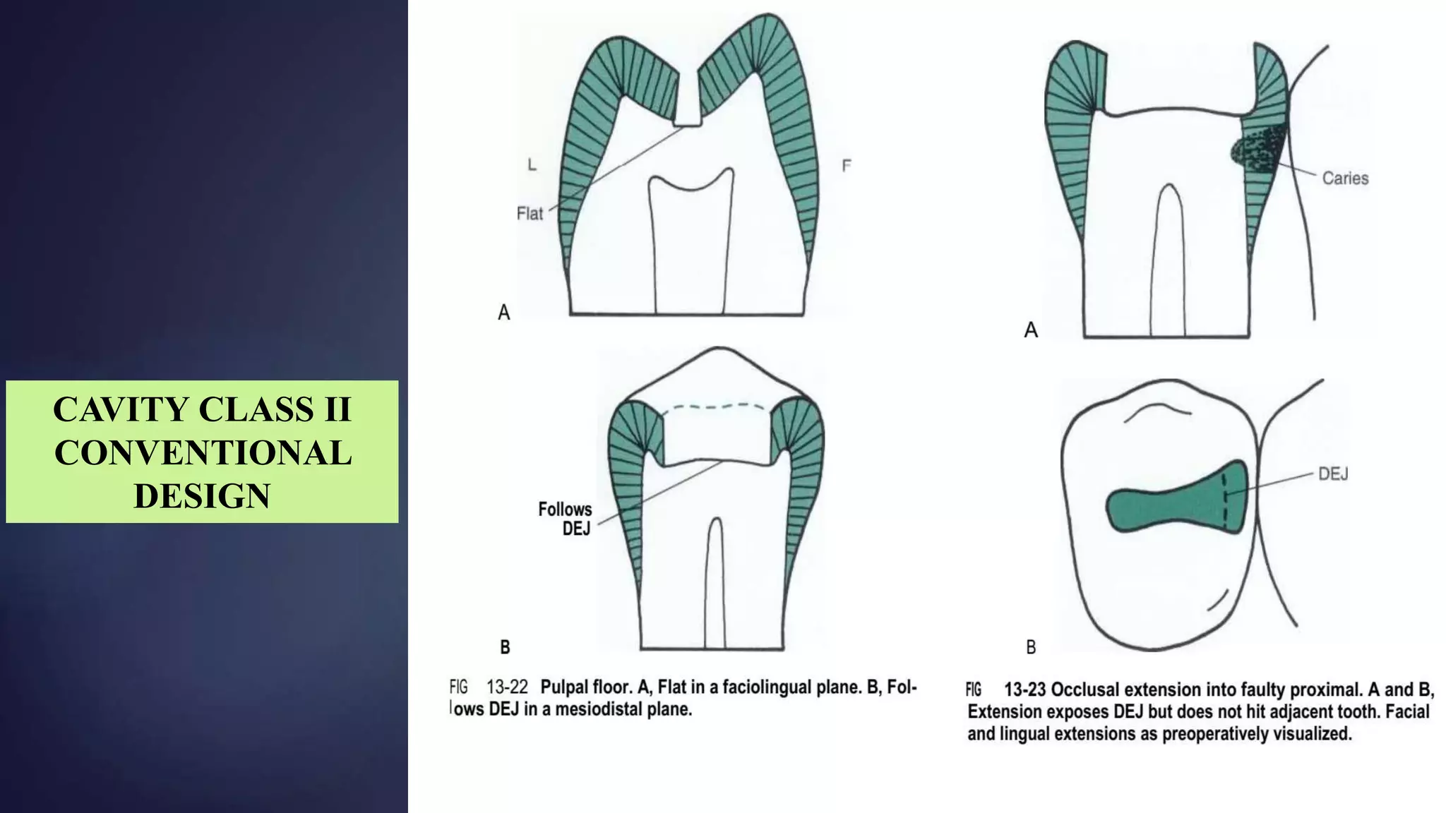 CAVITY CLASS II
CONVENTIONAL
DESIGN
 