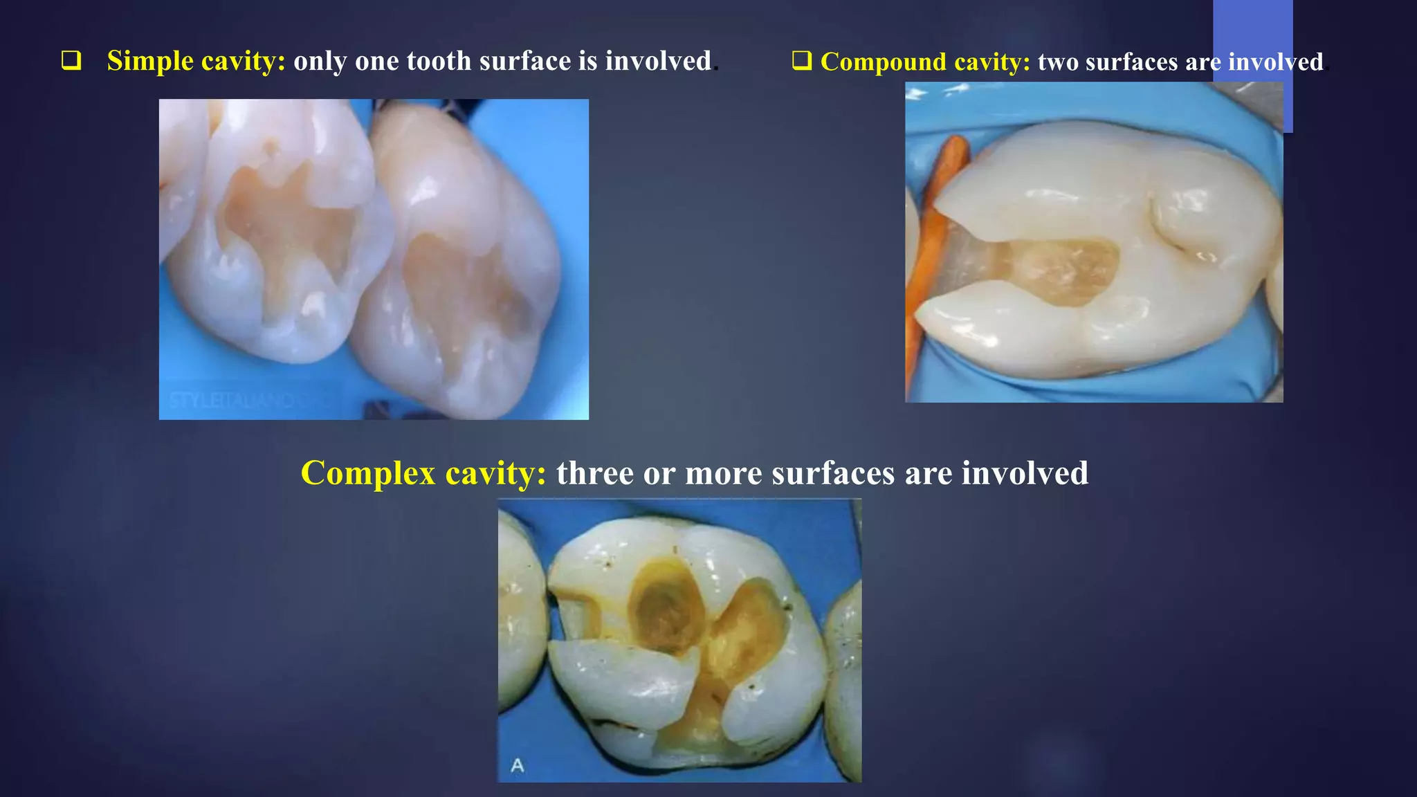 Class I II Composites Cavity preparations PPTX