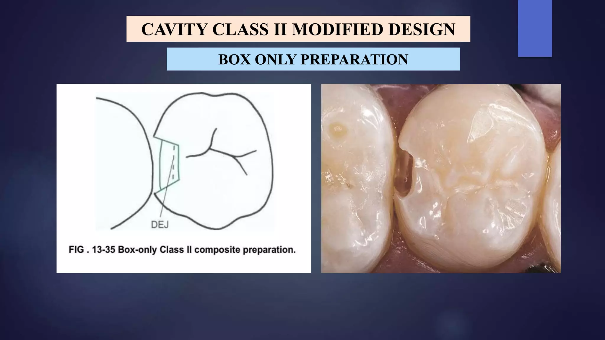 CAVITY CLASS II MODIFIED DESIGN
BOX ONLY PREPARATION
 