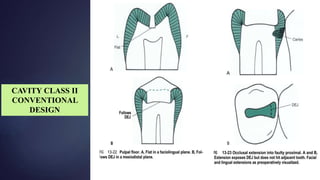 Class I , II Composites Cavity preparations | PPTX