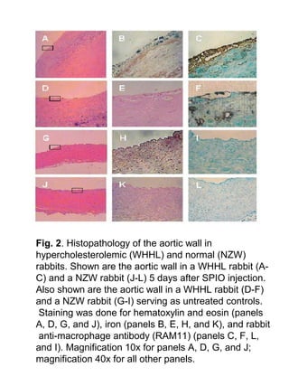 Fig. 2. Histopathology of the aortic wall in
hypercholesterolemic (WHHL) and normal (NZW)
rabbits. Shown are the aortic wall in a WHHL rabbit (A-
C) and a NZW rabbit (J-L) 5 days after SPIO injection.
Also shown are the aortic wall in a WHHL rabbit (D-F)
and a NZW rabbit (G-I) serving as untreated controls.
Staining was done for hematoxylin and eosin (panels
A, D, G, and J), iron (panels B, E, H, and K), and rabbit
anti-macrophage antibody (RAM11) (panels C, F, L,
and I). Magnification 10x for panels A, D, G, and J;
magnification 40x for all other panels.
 