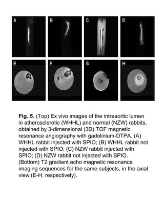 Fig. 5. (Top) Ex vivo images of the intraaortic lumen
in atherosclerotic (WHHL) and normal (NZW) rabbits,
obtained by 3-dimensional (3D) TOF magnetic
resonance angiography with gadolinium-DTPA. (A)
WHHL rabbit injected with SPIO; (B) WHHL rabbit not
injected with SPIO; (C) NZW rabbit injected with
SPIO; (D) NZW rabbit not injected with SPIO.
(Bottom) T2 gradient echo magnetic resonance
imaging sequences for the same subjects, in the axial
view (E-H, respectively).
 