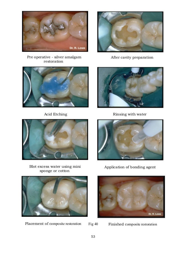 acid etching/ rotary endodontic courses by indian dental academy
