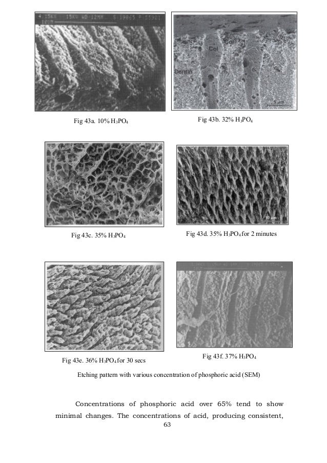 acid etching/ rotary endodontic courses by indian dental academy