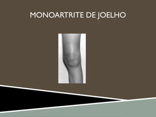 MONOARTRITE DE JOELHO
 