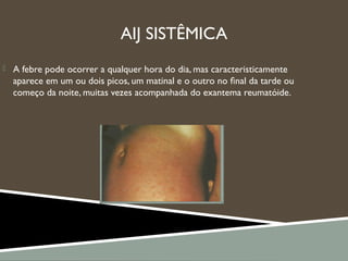 AIJ SISTÊMICA
 A febre pode ocorrer a qualquer hora do dia, mas caracteristicamente
aparece em um ou dois picos, um matinal e o outro no ﬁnal da tarde ou
começo da noite, muitas vezes acompanhada do exantema reumatóide.
 