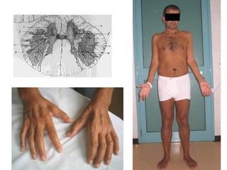 UMN-D
C.A: 41 years
4 years after the onset